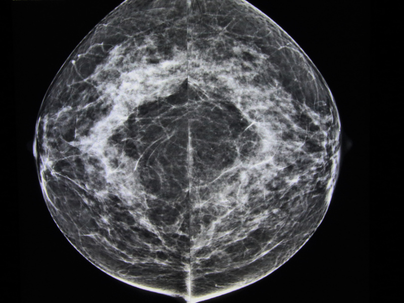 Imagerie mammaire